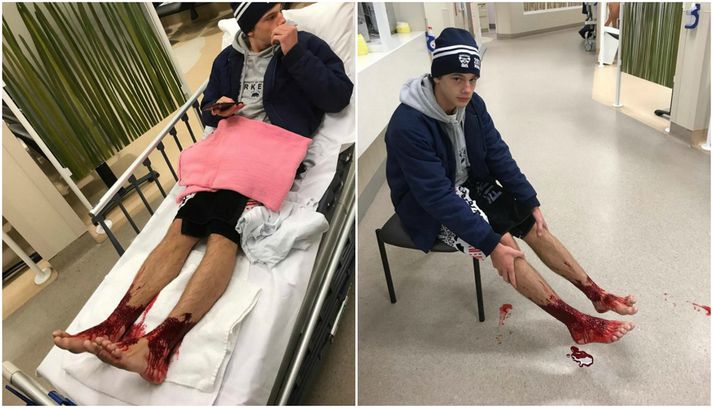 Eftir um þrjátíu mínútna bað kom Sam Kanizay aftur á land en þá voru fætur hans þaktir litlum stungusárum sem mikið blæddi úr.