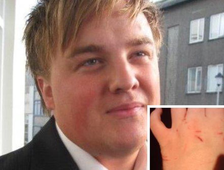 Andri Snær er ennþá mikið bólginn eftir að köttur í nágrenninu beit hann.