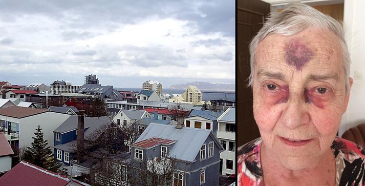Anna segist öll vera að koma til, þó að hún sé engin fegurðardrottning eins og er.