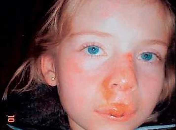 Emma Ljósbrá marðist nokkuð í andliti