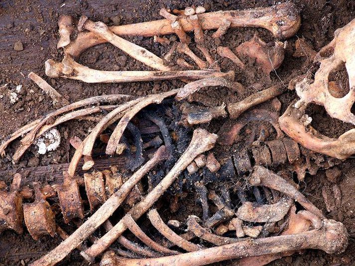 Beinagrind úr Skriðuklaustursrannsóknum  Á myndinni má sjá greinileg ummerki sulls en hvíta kúlan er leifar kalkgerðar blöðru sem sullaveikibandormurinn hefst við í.