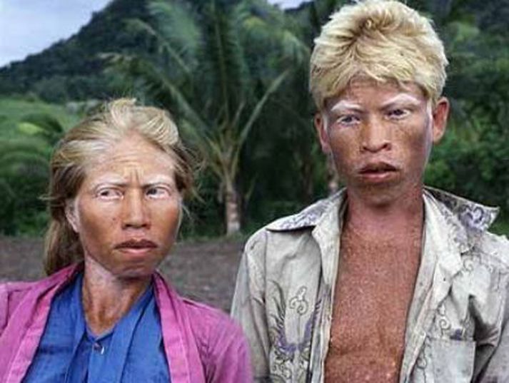 Albínóar. Athugið að myndin tengist ekki fréttinni beint.