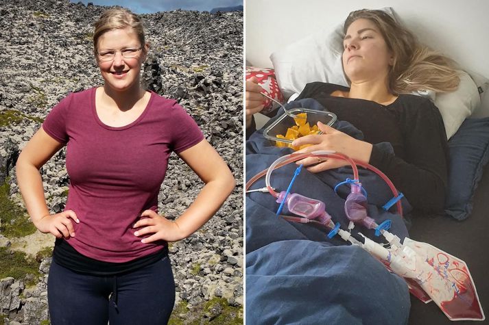 Ásta Erla Jónasdóttir var tvítug þegar hún fékk sér PIP brjóstapúða, árið 2008. 