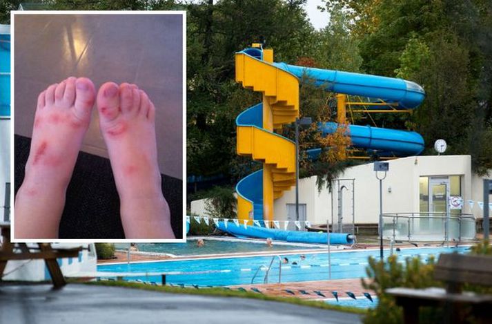 Elín telur ólíklegt að sárin hafi hlotist af völdum gúmmísins, hugsanlega sé um að ræða viðkvæma húð barnsins. Hún fullyrðir þó ekkert og leitar nú skýringa.