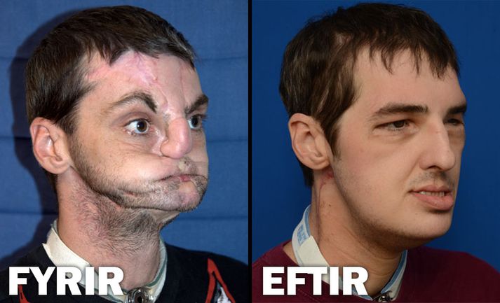 Samsett mynd sem sýnir Norris fyrir og eftir aðgerðina.