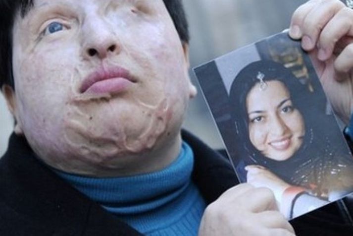 Ameneh Bahrami, írönsk kona, þurfti að þola sýruárás árið 2004 frá hendi manns sem hafði beðið um hönd hennar en hún hafnaði ráðahagnum. Hún er afmynduð í dag, en hér heldur hún á mynd af sér eins og hún leit út fyrir árásina.