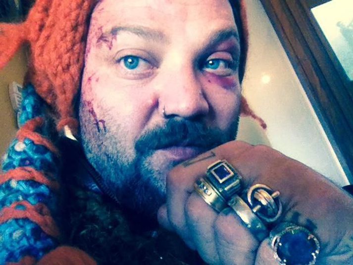 Bam Margera eftir slaginn.