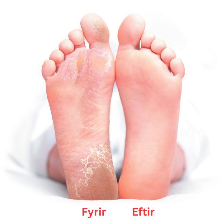 Baby Foot Peel fótamaskinn er áhrifarík ávaxtasýrumeðferð fyrir fætur sem þú getur notað í stofunni heima hjá þér.