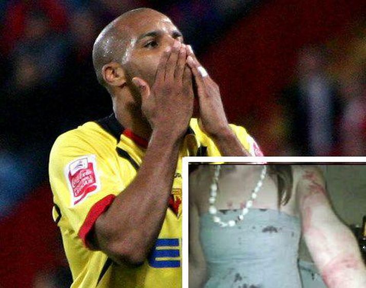 Marlon King og áverkar á Emily eftir árásina.