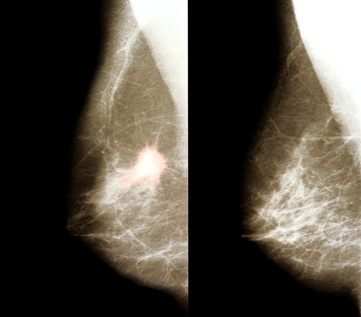 „Það er sjaldgæft að við sjáum svona skýrar niðurstöður,“ segir Óskar Þór Jóhannsson krabbameinslæknir og sérfræðingur í erfðum brjóstakrabbameina.