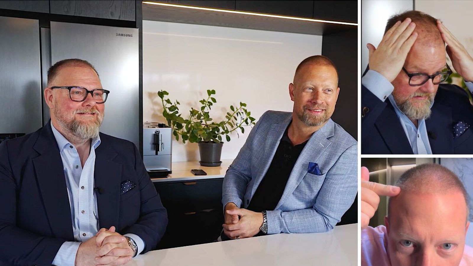 Svona heppnaðist hárígræðslan hjá Baldri og Einari