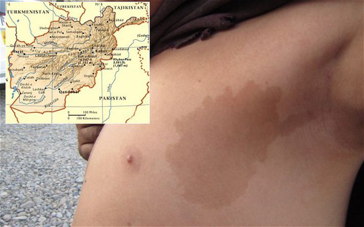 Eins og sjá má er fæðingarbletturinn ansi líkur landsvæði Afganistan.
