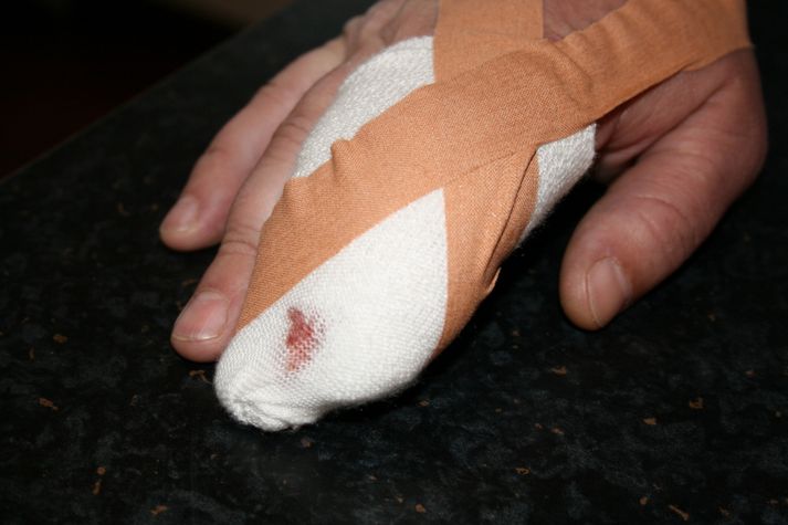 Ekki var hægt að sauma fingur lögreglumannsins sem brotnaði við bitið.