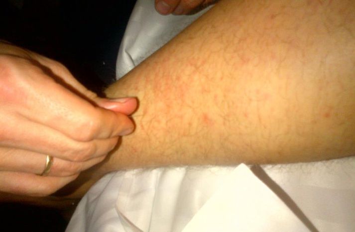 Kolbeinn Sigþórsson fór í nálastungu hjá Friðriki Ellert Jónssyni, sjúkraþjálfara landsliðsins í morgun.