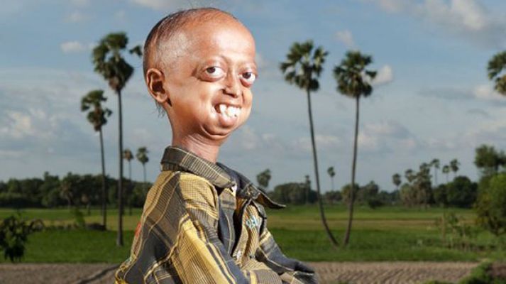 Ali Hussein vonar að lækning finnist við sjúkdóminum Progeria