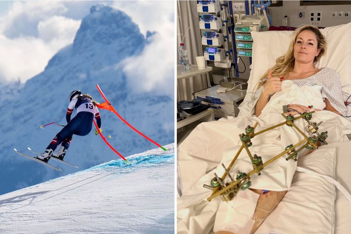 Lindsey Vonn datt harkalega og fótbrotnaði en er á batavegi. 