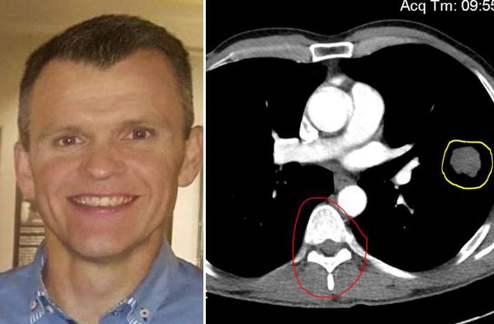 Sigurbjörn Árni segist stefna á að komast í hóp þeirra sem losna við krabbameinið. Hann ætli að halda sér jákvæðum í gegnum ferlið.