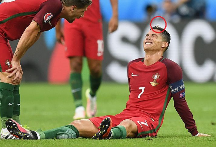 Ronaldo lenti saman við leikmann Frakka í úrslitaleik EM í gær og þegar hann sat á vellinum í öngum sínum tyllti sér fiðrildi á andlit hans.