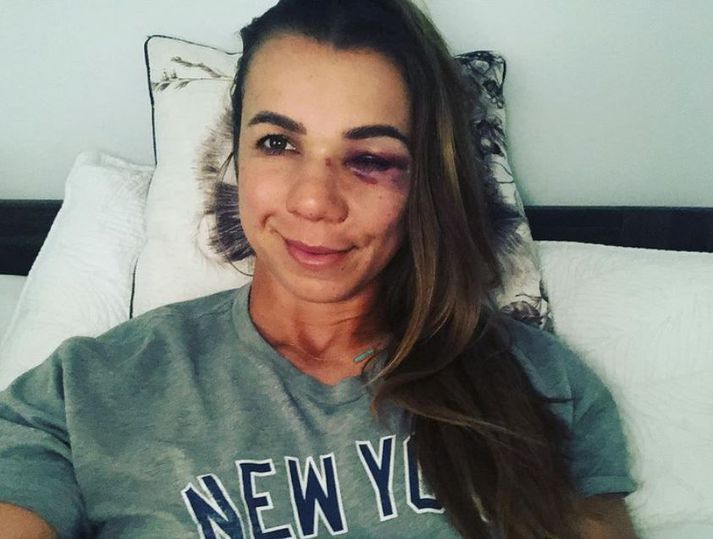 Rachel Balkovec sýndi glóðaraugað á Instagram.