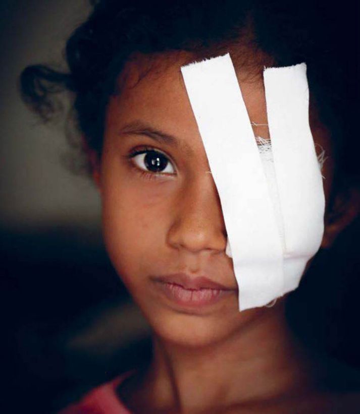 Razan, átta ára stelpa frá Jemen, sem slasaðist alvarlega í stríðsátökum.