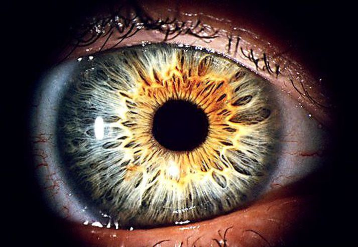 Í febrúar í 2012 voru 710 einstaklingar á biðlista eftir aðgerð á augasteini, borið saman við þá rúmlega 1200 sem nú bíða. Er um sjötíu prósent fjölgun að ræða.