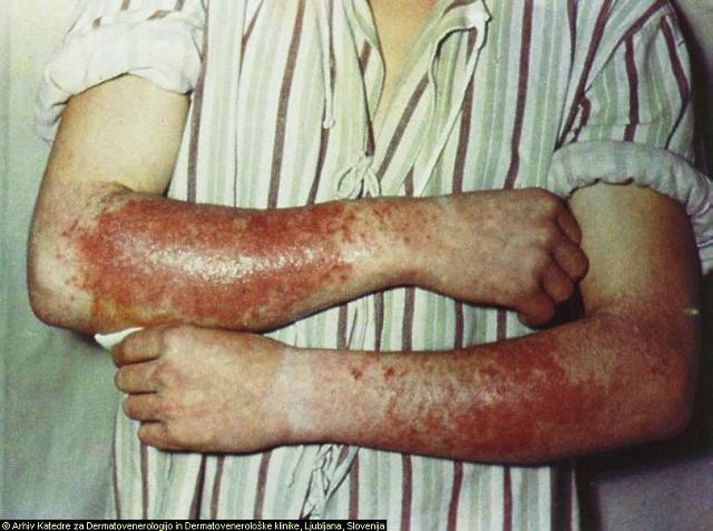 Ofnæmi. Sjúkdómurinn hrjáir sífellt fleiri í hinum vestræna heimi og rannsóknir benda til að venjulegar snyrtivörur geti haft talsverð áhrif þar á.