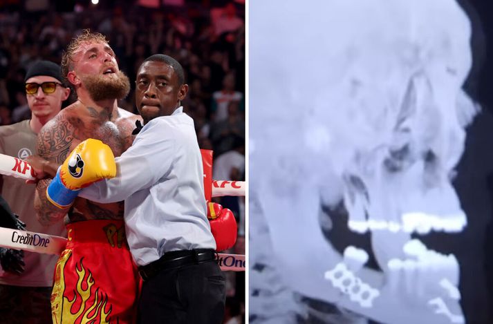 Jake Paul þurfti að fara í aðgerð eftir bardagann gegn Anthony Joshua.