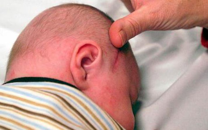 Drengurinn, Sam Esquibel, eftir aðgerðina.