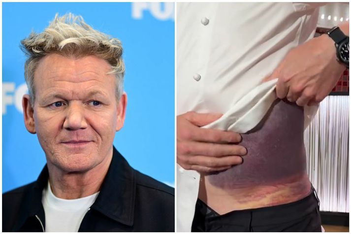Ramsay lenti í svæsnu reiðhjólaslysi í vikunni.