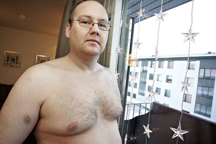 Ágúst Fylkisson Var stunginn þrisvar með skrúfjárni þegar hann reyndi að koma tveimur ungum stúlkum til hjálpar á nýársnótt. Fréttablaðið/Daníel