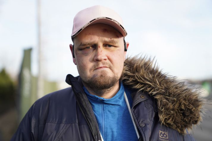 Eins og sjá má er Daníel Örn vel lemstraður eftir árásina.