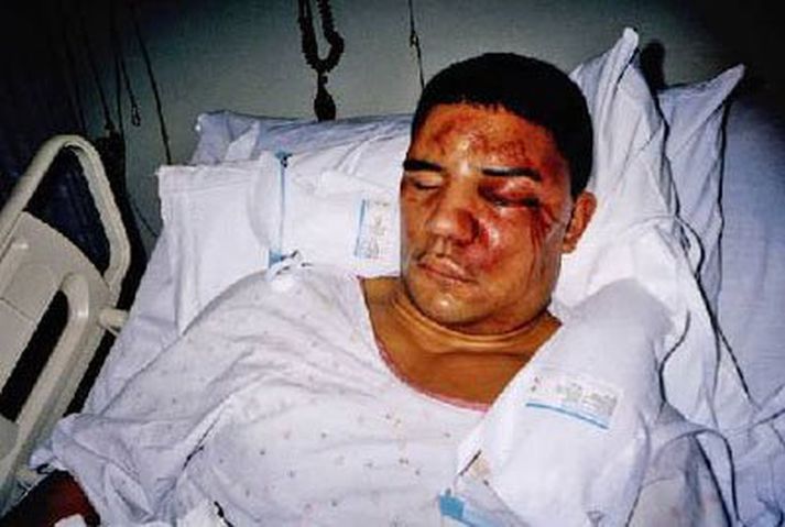 Svona leit Rodney King út eftir barsmíðarnar árið 1991
